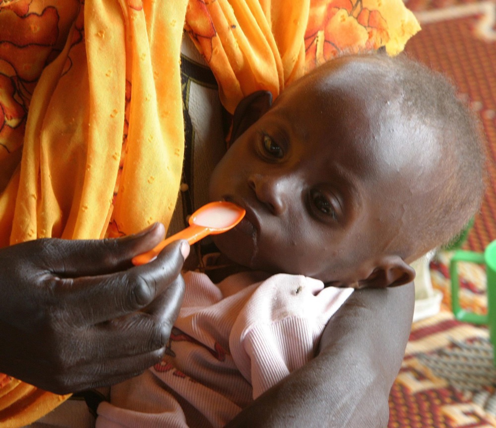 طفل مصاب بسوء التغذية في إقليم دارفور بالسودان