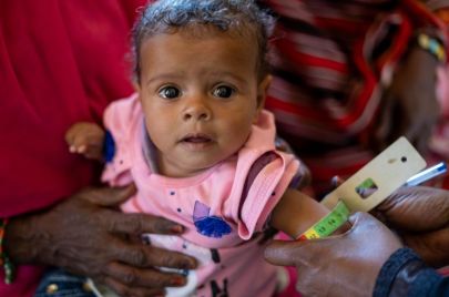 (610) ألف طفل في السودان يعانون من الهزال الشديد