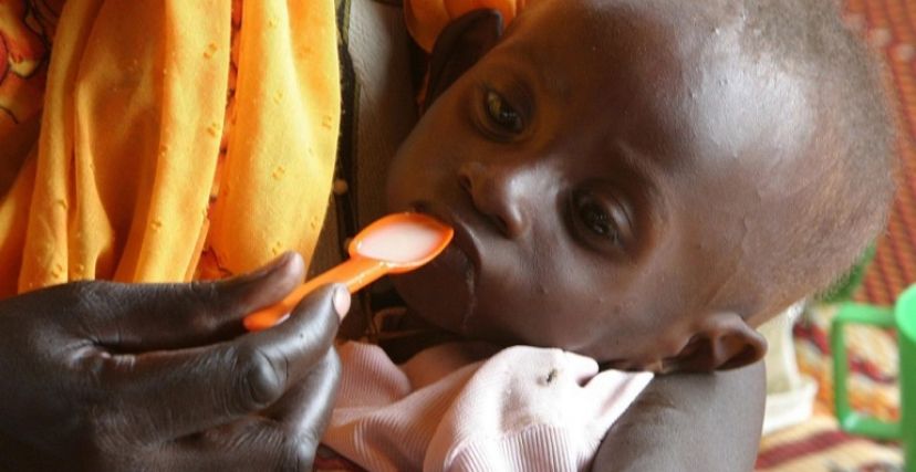طفل سوداني يعاني من سوء التغذية الحاد
